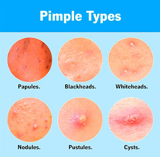 Skin Care Experts Debunk Myths About Pimples - Allproductreview.com